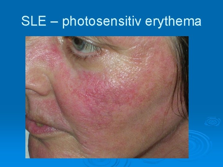 SLE – photosensitiv erythema 