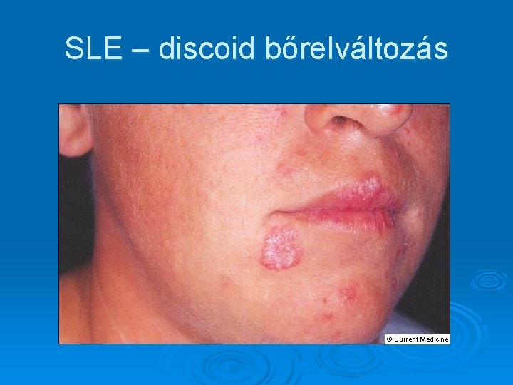 SLE – discoid bőrelváltozás 