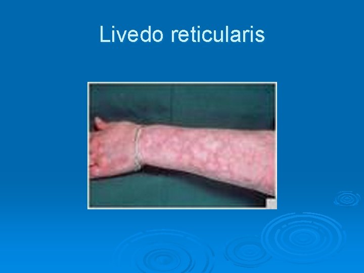 Livedo reticularis 