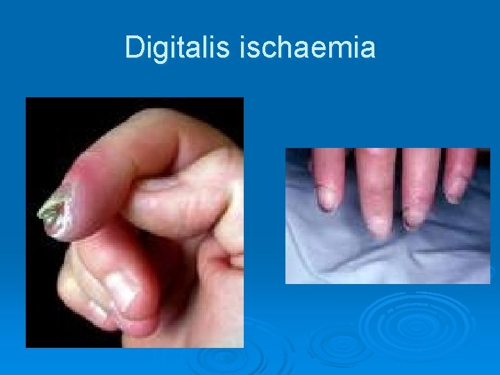 Digitalis ischaemia 