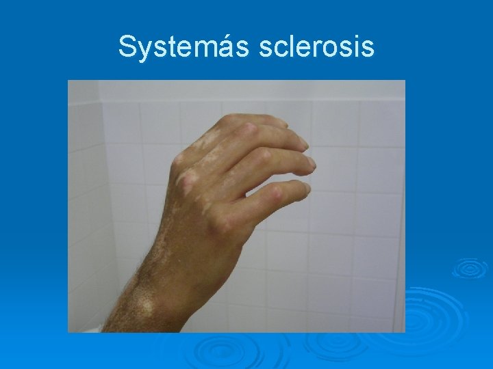 Systemás sclerosis 
