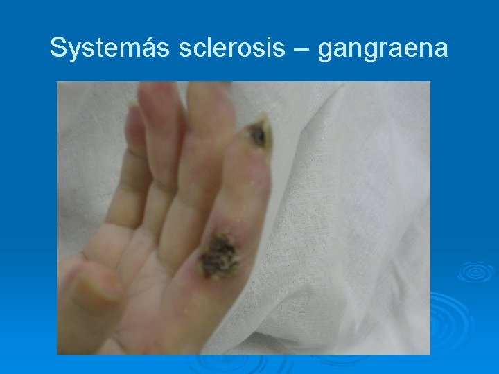 Systemás sclerosis – gangraena 