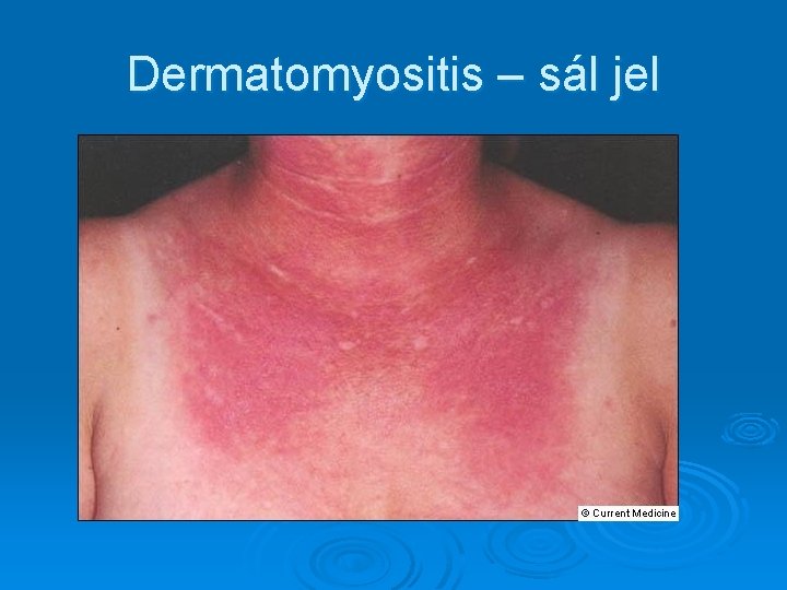 Dermatomyositis – sál jel 
