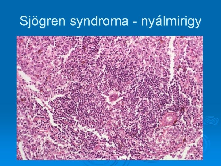 Sjögren syndroma - nyálmirigy 