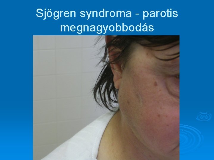 Sjögren syndroma - parotis megnagyobbodás 