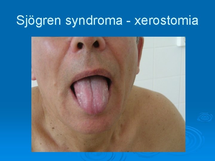 Sjögren syndroma - xerostomia 