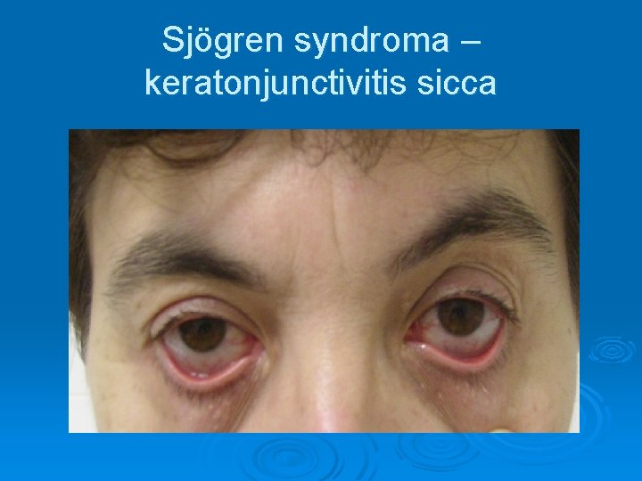 Sjögren syndroma – keratonjunctivitis sicca 