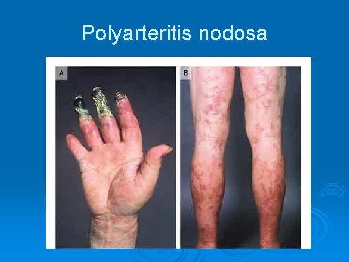 Polyarteritis nodosa 