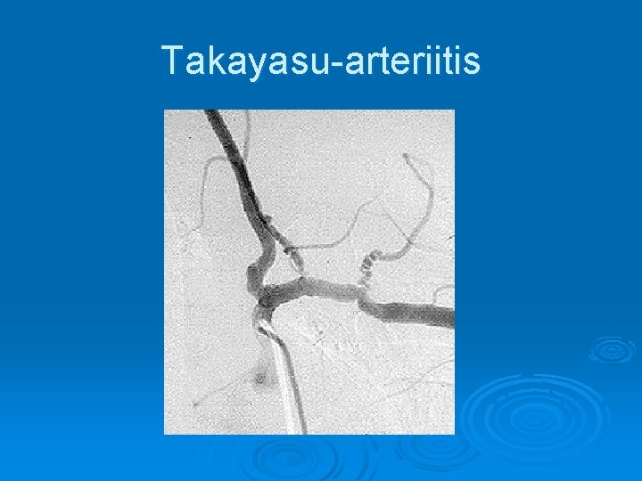 Takayasu-arteriitis 