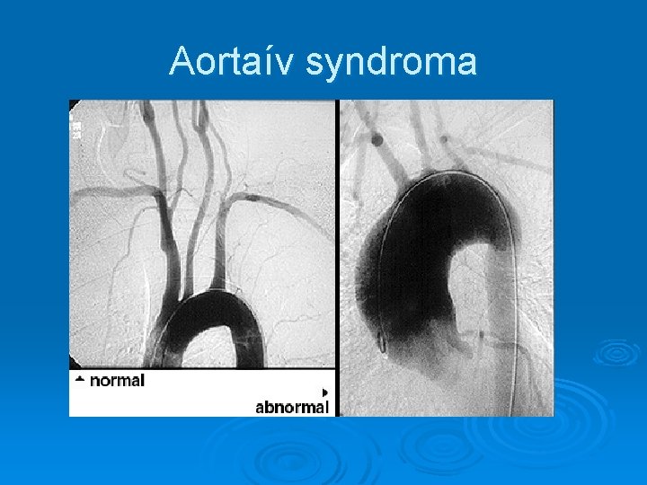 Aortaív syndroma 
