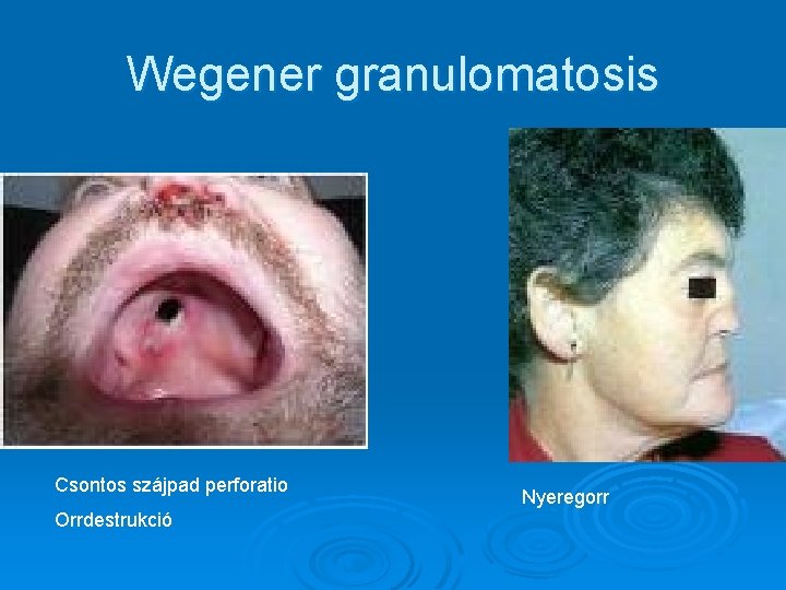 Wegener granulomatosis Csontos szájpad perforatio Orrdestrukció Nyeregorr 