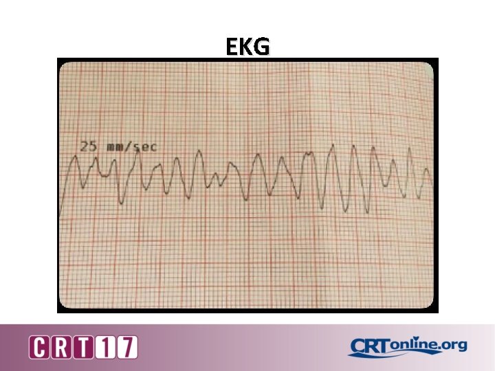 EKG 