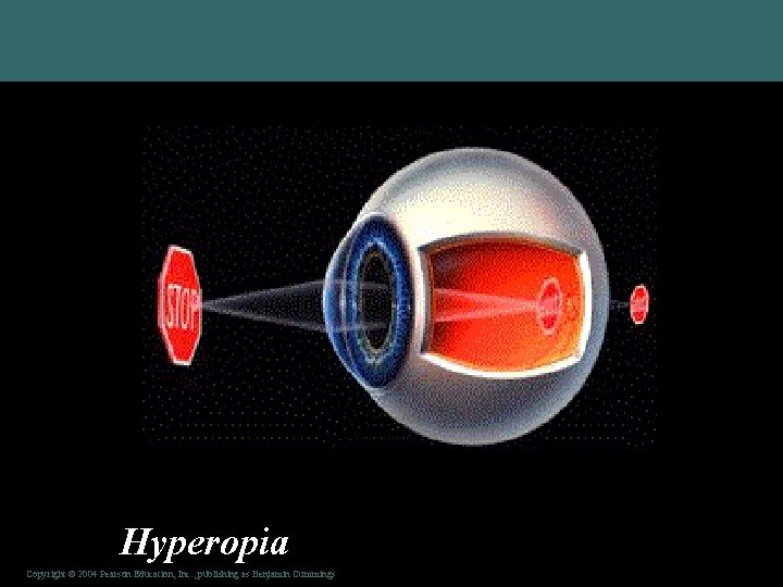 Hyperopia Copyright © 2004 Pearson Education, Inc. , publishing as Benjamin Cummings 