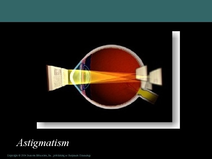  • Unequal curvatures in cornea & lens Astigmatism Copyright © 2004 Pearson Education,