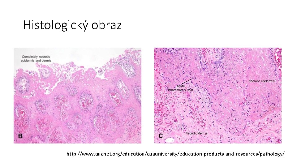 Histologický obraz http: //www. auanet. org/education/auauniversity/education-products-and-resources/pathology/ 
