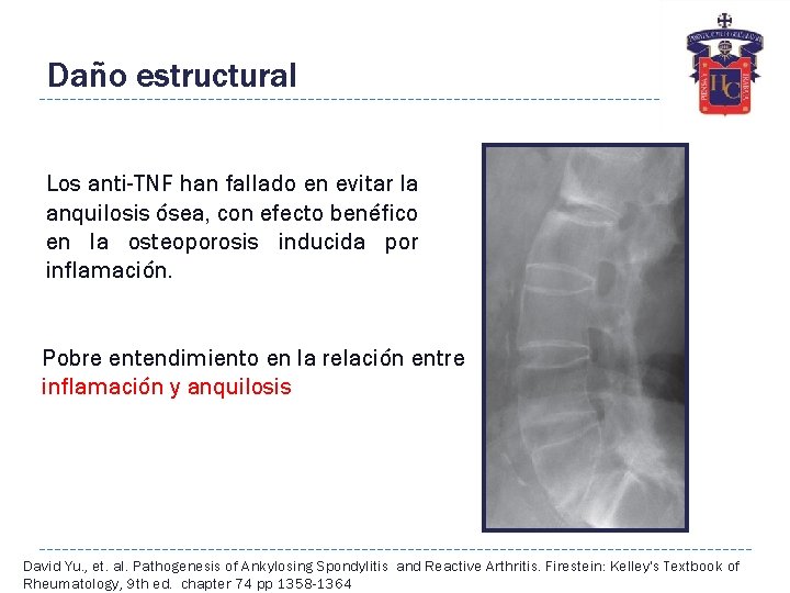 Daño estructural Los anti-TNF han fallado en evitar la anquilosis ósea, con efecto benéfico
