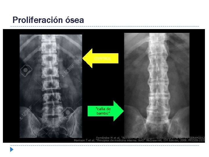 Proliferación ósea 