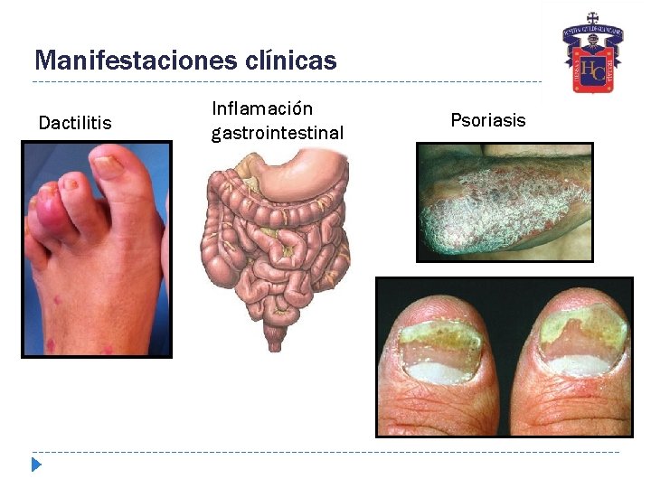 Manifestaciones clínicas Dactilitis Inflamación gastrointestinal Psoriasis 