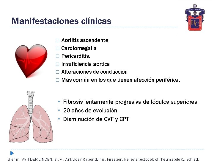 Manifestaciones clínicas � � � Aortitis ascendente Cardiomegalia Pericarditis. Insuficiencia aórtica Alteraciones de conducción