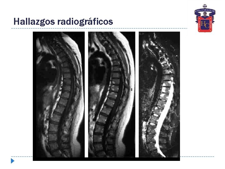 Hallazgos radiográficos 