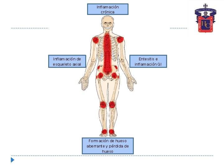 Inflamación crónica Inflamación de esqueleto axial Entesitis e inflamación GI Formación de hueso aberrante