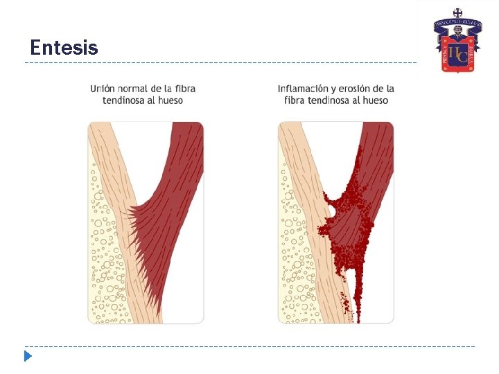 Entesis 