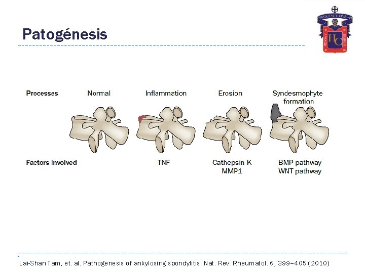 Patogénesis Lai-Shan Tam, et. al. Pathogenesis of ankylosing spondylitis. Nat. Rev. Rheumatol. 6, 399–