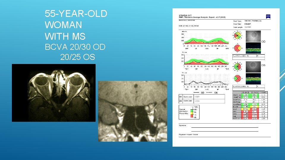 55 -YEAR-OLD WOMAN WITH MS BCVA 20/30 OD 20/25 OS 