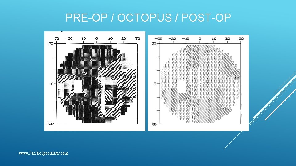 PRE-OP / OCTOPUS / POST-OP www. Pacific. Specialists. com 