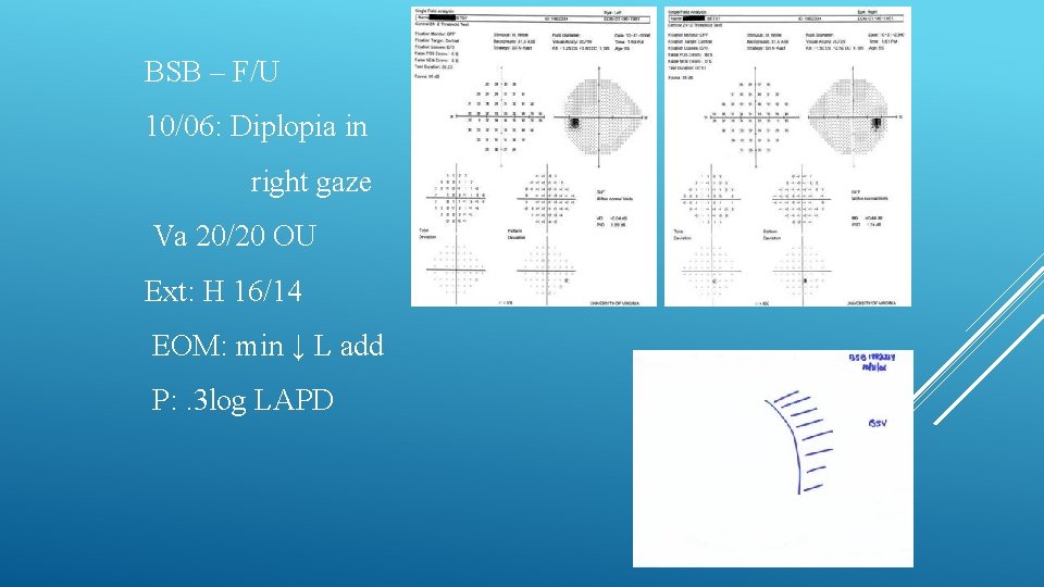 BSB – F/U 10/06: Diplopia in right gaze Va 20/20 OU Ext: H 16/14