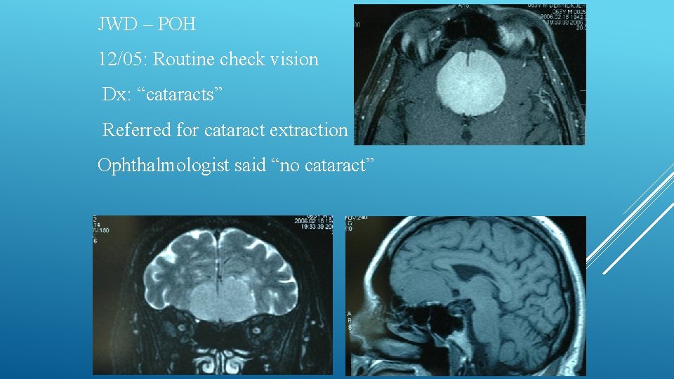 JWD – POH 12/05: Routine check vision Dx: “cataracts” Referred for cataract extraction Ophthalmologist