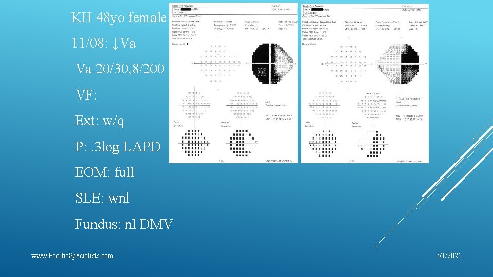 KH 48 yo female 11/08: ↓Va Va 20/30, 8/200 VF: Ext: w/q P: .