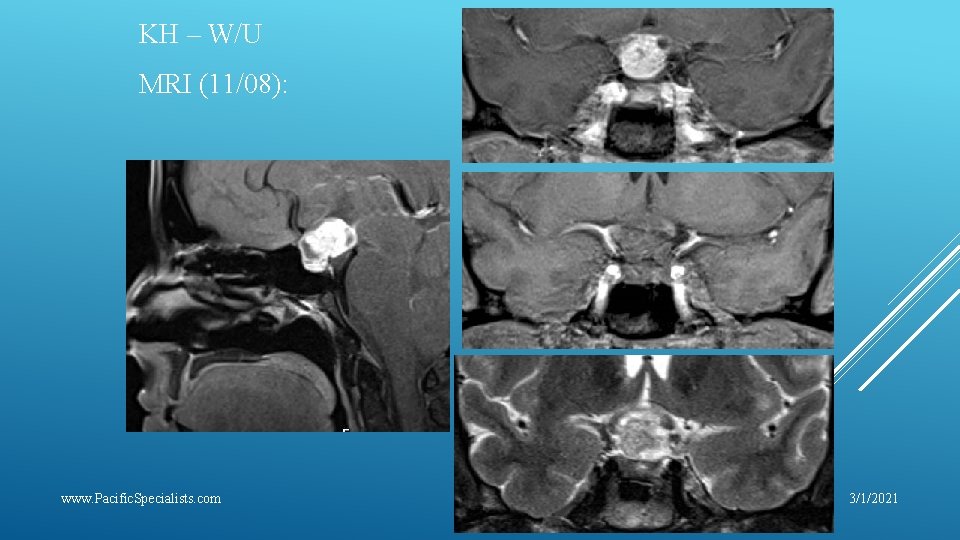 KH – W/U MRI (11/08): www. Pacific. Specialists. com 3/1/2021 