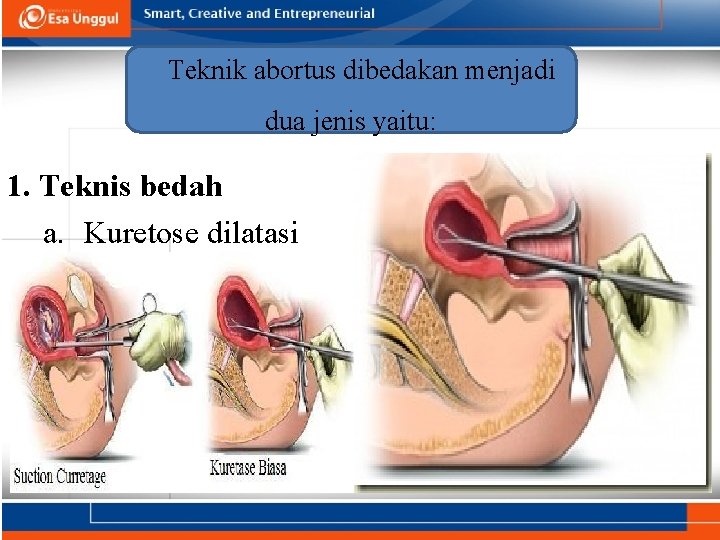 Teknik abortus dibedakan menjadi dua jenis yaitu: 1. Teknis bedah a. Kuretose dilatasi 