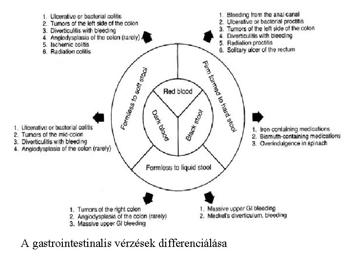 A gastrointestinalis vérzések differenciálása 