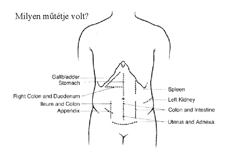 Milyen műtétje volt? 