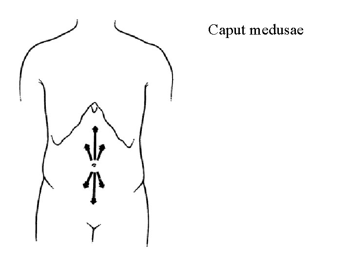 Caput medusae 