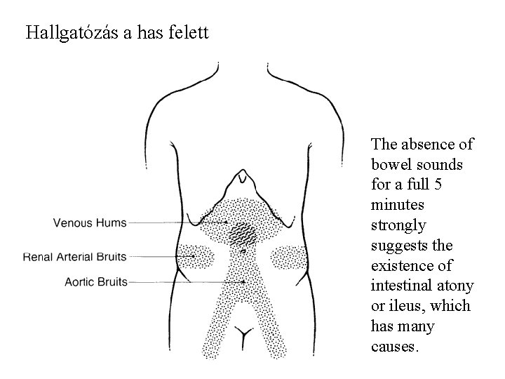 Hallgatózás a has felett The absence of bowel sounds for a full 5 minutes