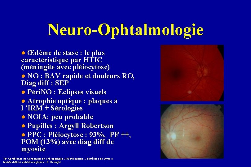Neuro-Ophtalmologie ● Œdème de stase : le plus caractéristique par HTIC (méningite avec pléiocytose)