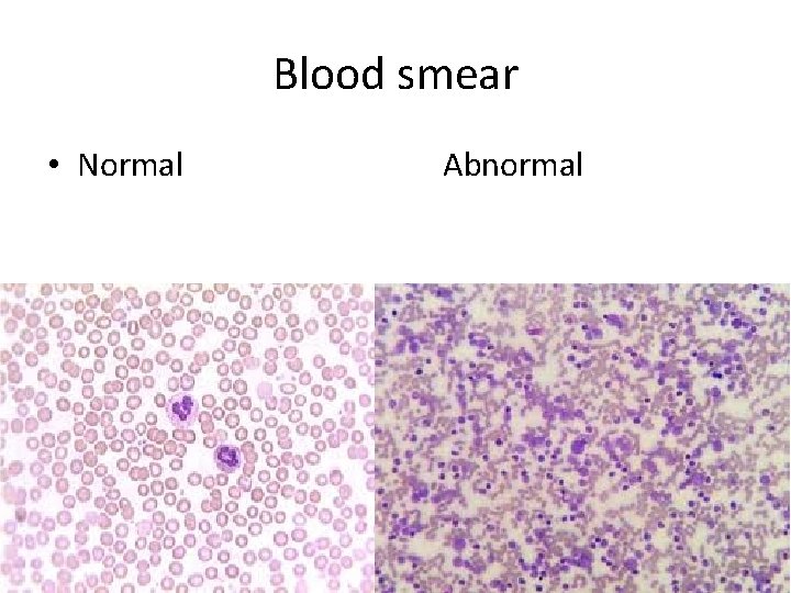 Blood smear • Normal Abnormal 