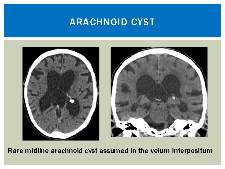 Guide to intracranial cysts A Cystomatic approach Bryan