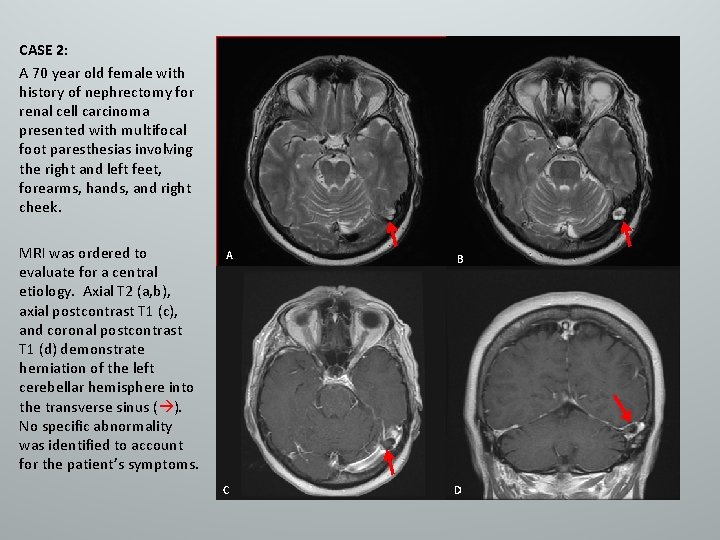 CASE 2: A 70 year old female with history of nephrectomy for renal cell