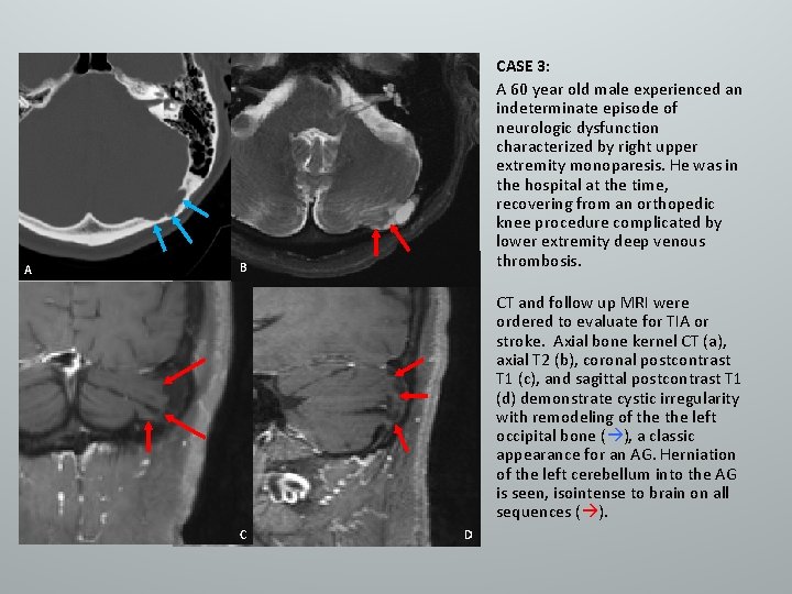 A CASE 3: A 60 year old male experienced an indeterminate episode of neurologic