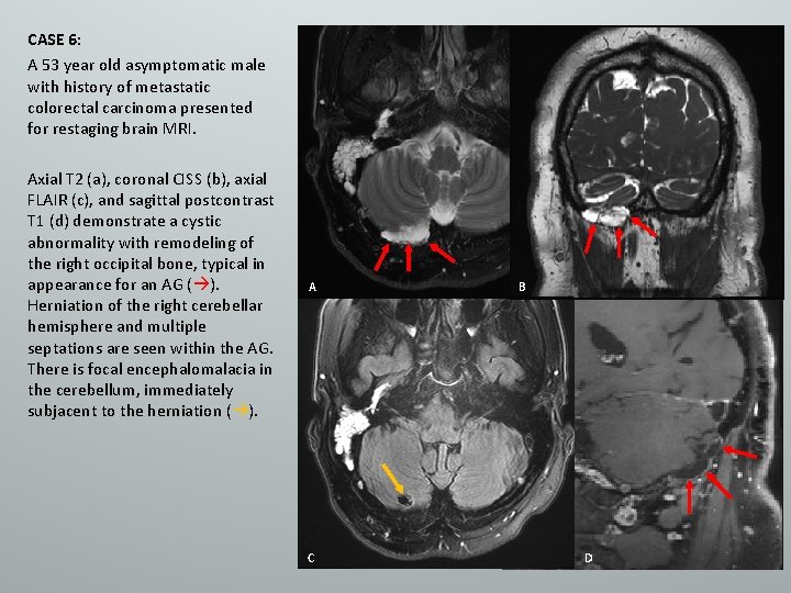 CASE 6: A 53 year old asymptomatic male with history of metastatic colorectal carcinoma