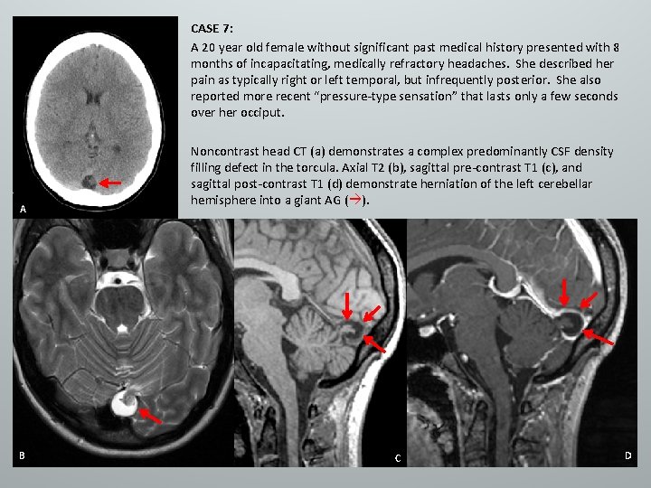 CASE 7: A 20 year old female without significant past medical history presented with