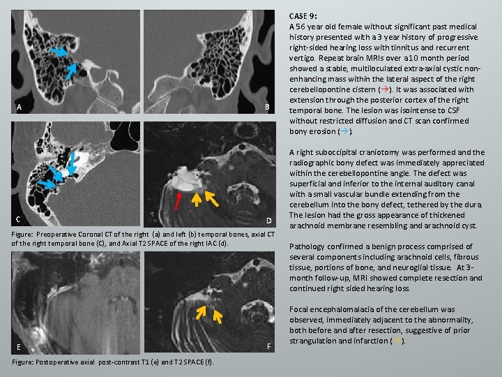 A C B D Figure: Preoperative Coronal CT of the right (a) and left