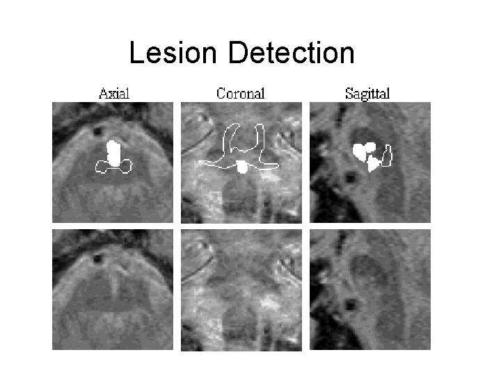 Lesion Detection 