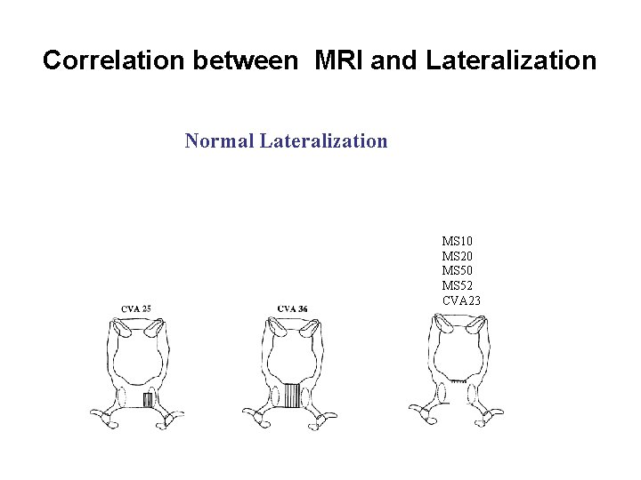 Correlation between MRI and Lateralization Normal Lateralization MS 10 MS 20 MS 52 CVA