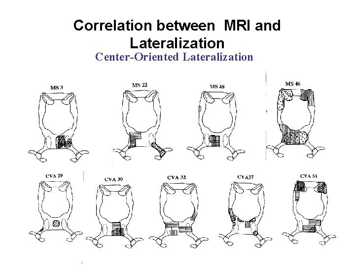 Correlation between MRI and Lateralization Center-Oriented Lateralization 