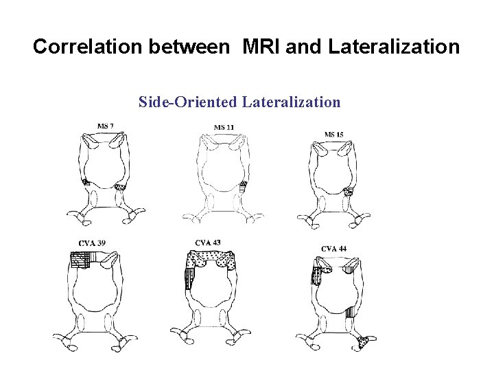 Correlation between MRI and Lateralization Side-Oriented Lateralization 